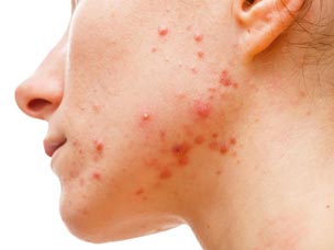 Acne scarring treatments in Warwickshire